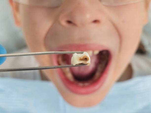 Best Emergency Tooth Extraction in New Madison, OH